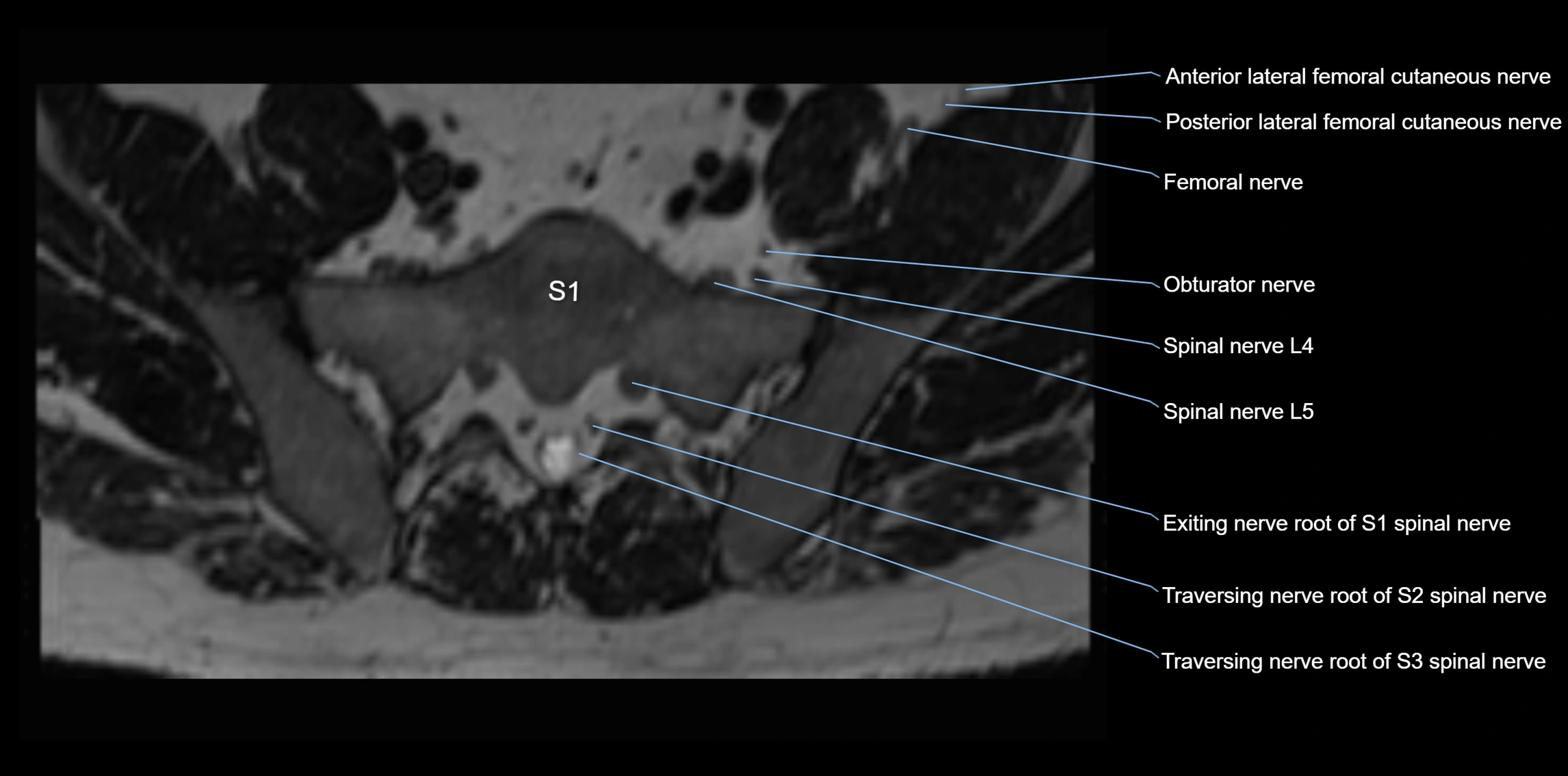 MR lumbosacral plexus axial cross sectional anatomy 3T  radiology  image-img-1008001-00073.webp